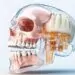 what-are-zygomatic-arch-implants