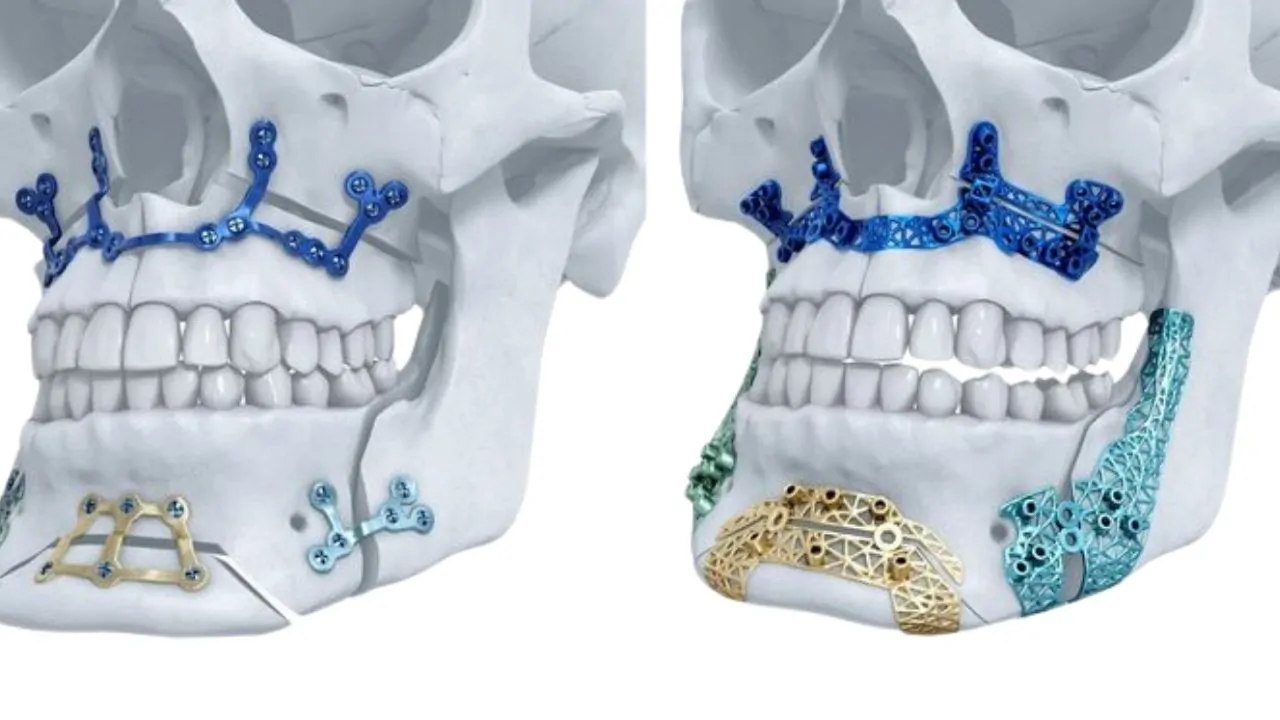 3d-printed-facial-implants