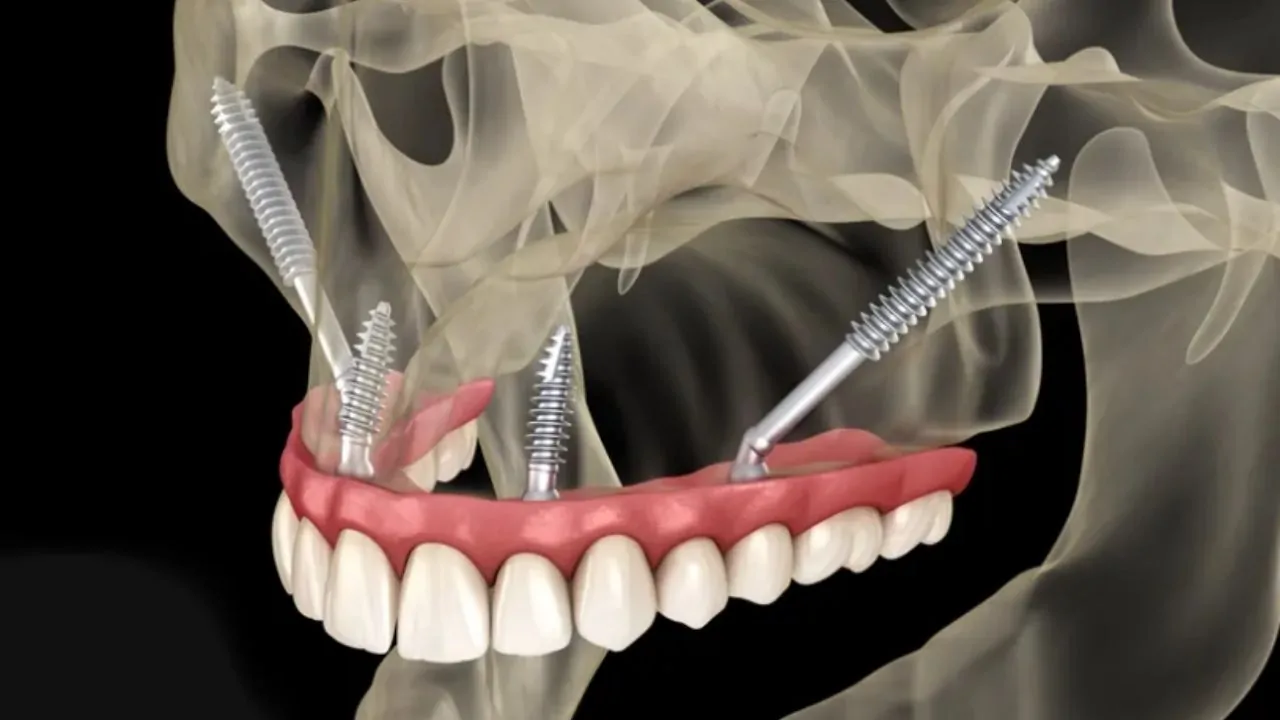 jaw-ankylosis-2 (1)