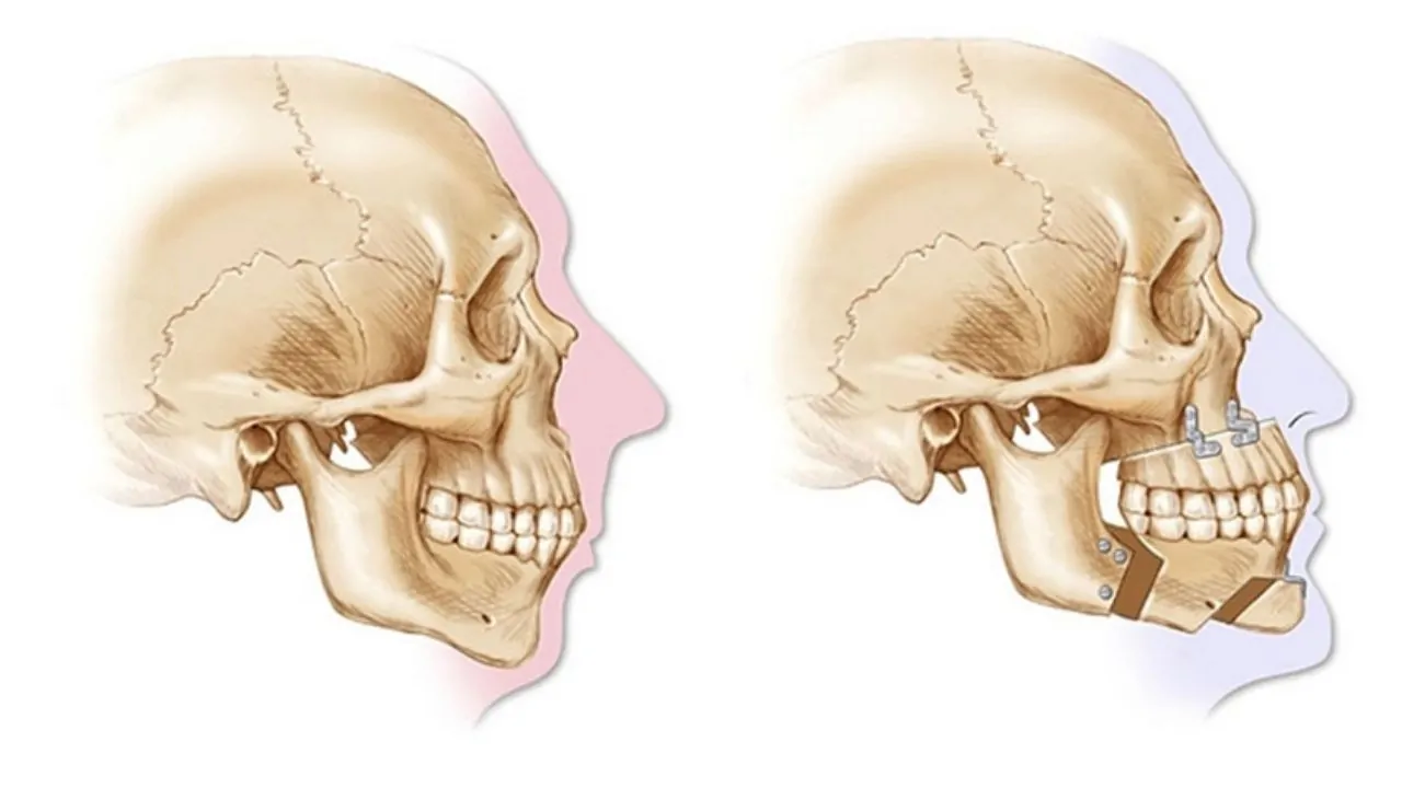 jaw-ankylosis-2