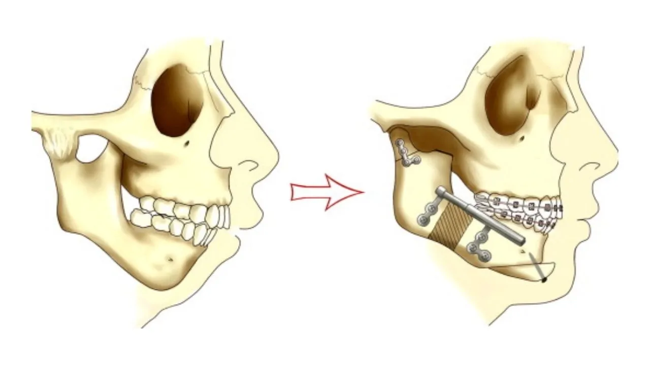 jaw-ankylosis