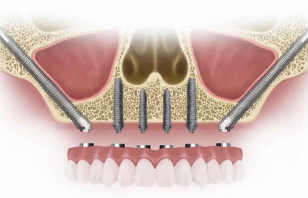 What is a Zygomatic Implant and How Does It Work in Turkey?