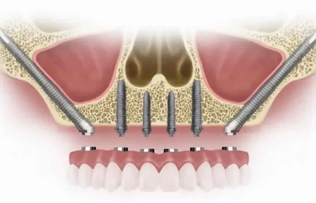 What is a Zygomatic Implant and How Does It Work in Turkey?