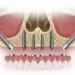 zygomatic-implants-turkey