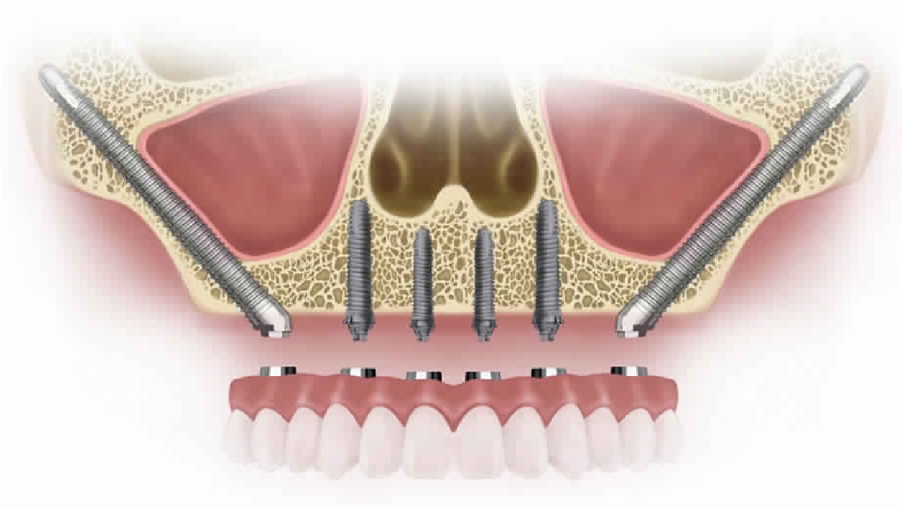 What is a Zygomatic Implant and How Does It Work in Turkey?