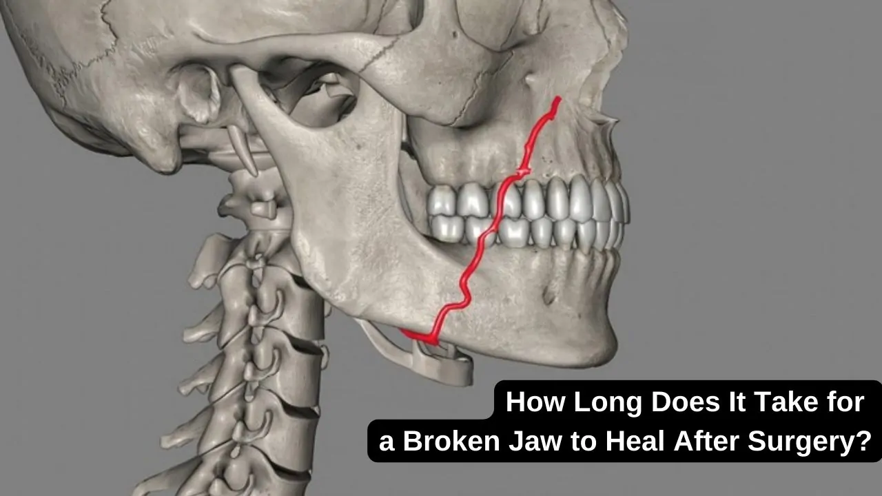 How Long Does It Take for a Broken Jaw to Heal After Surgery (1)