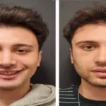 Jawline Surgery Before and After