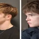 Jawline Surgery Before and After