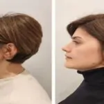 Jawline Surgery Before and After