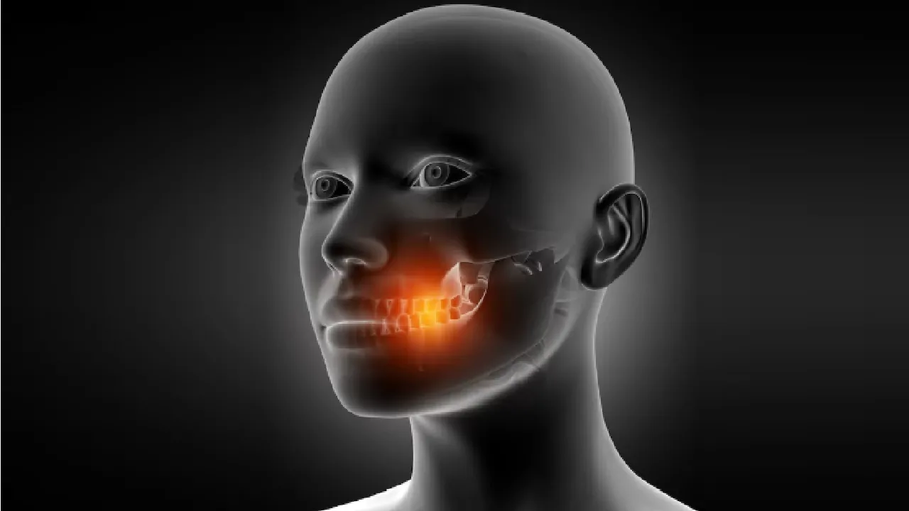 fracture of cheekbone