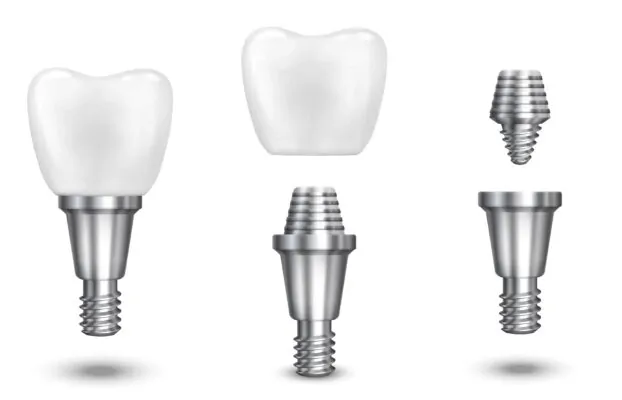 8 Tane İmplant Diş Ne Kadar? İmplant Fiyatları Neye Göre Değişir?