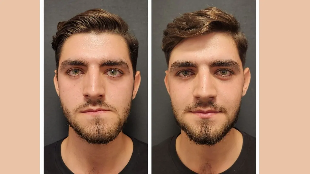 Can Jaw Surgery Change Your Face?