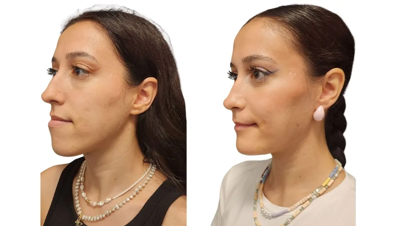 Can Jaw Surgery Change Your Face?