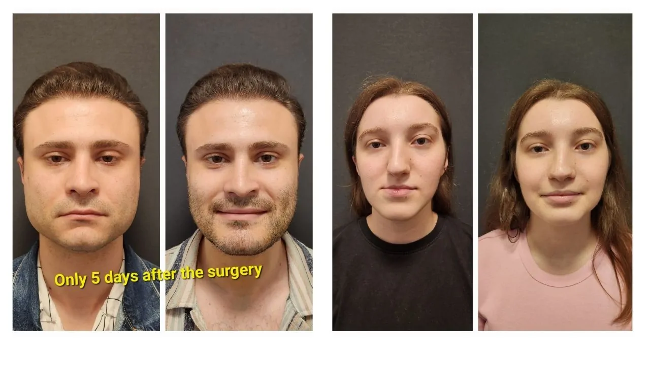 What is Cosmetic Jaw Surgery? Is Jaw Surgery Cosmetic?