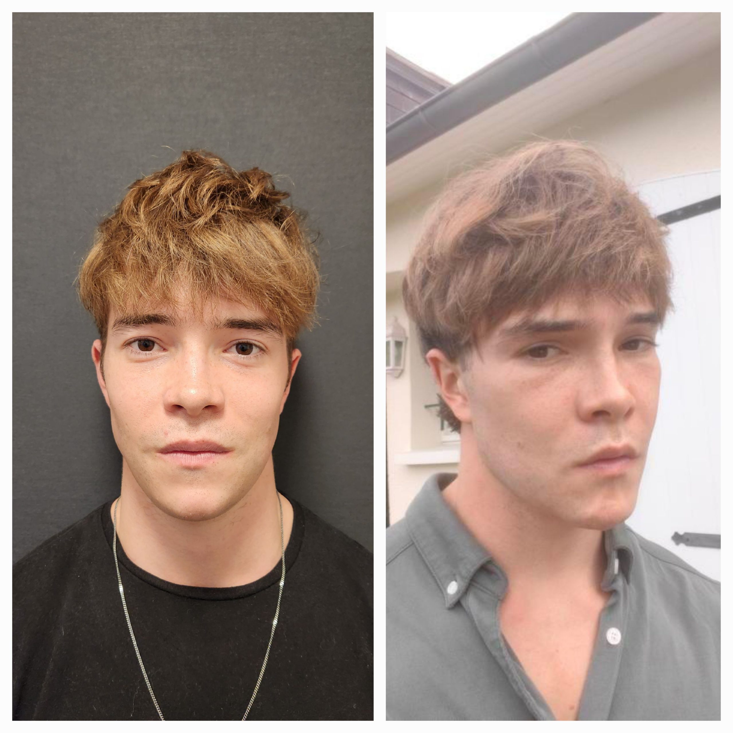 How Much Does A Jawline Implant Cost