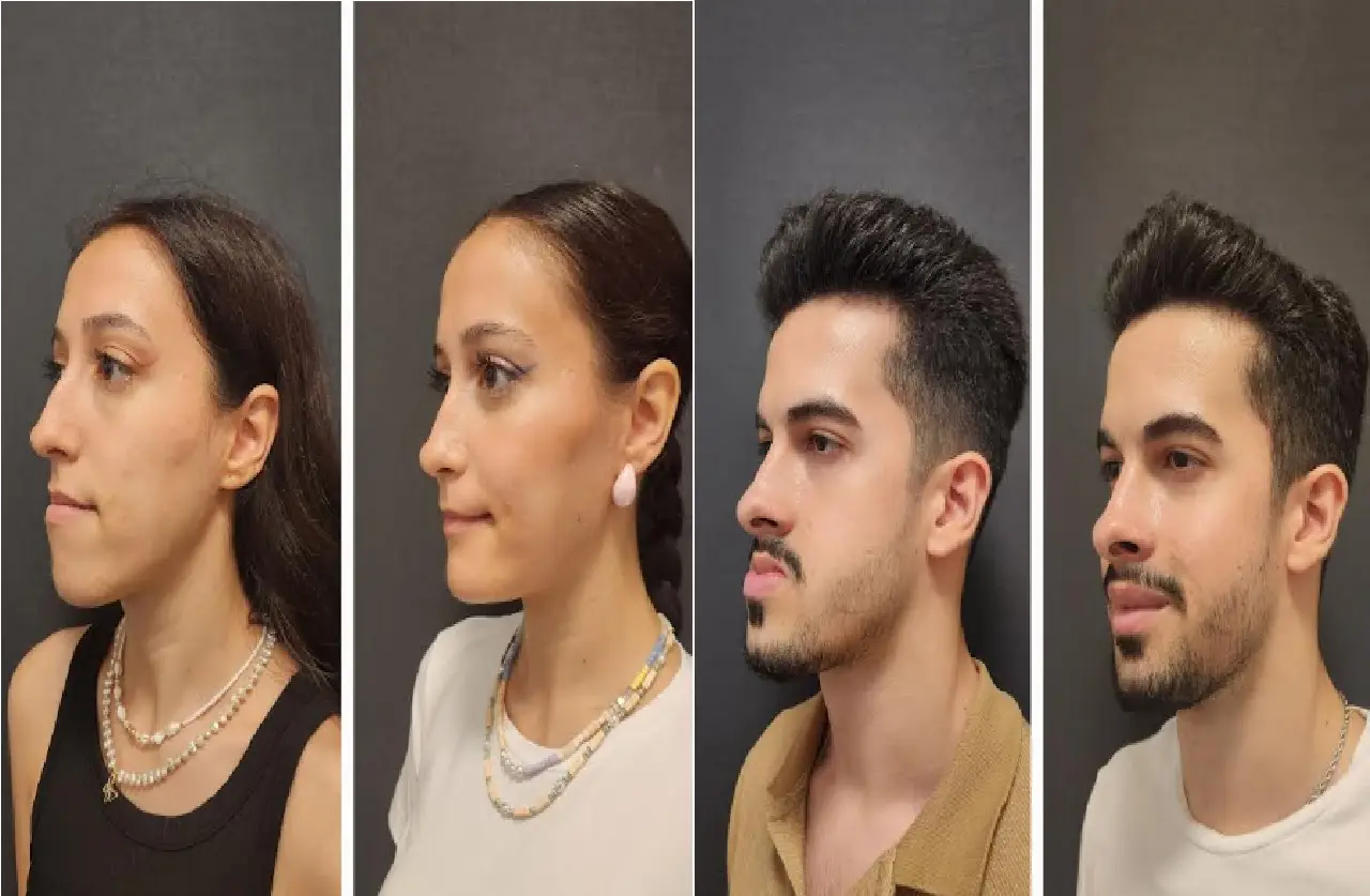 How Much Does A Jawline Implant Cost?