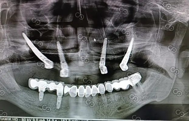 Üst Çene İmplant Bekleme Süresi Nedir? Tedavi Ne Kadar Sürer?