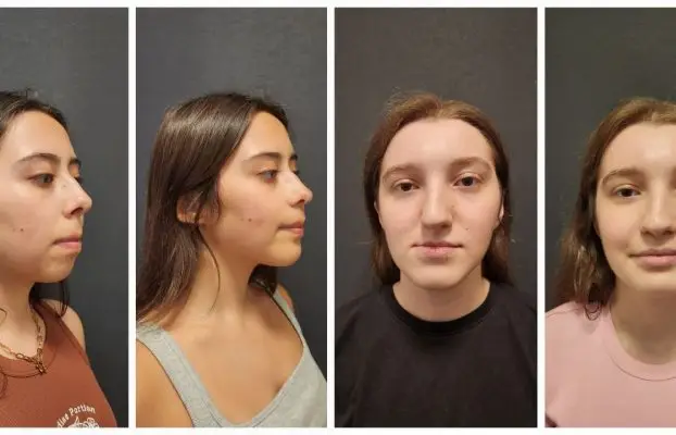 TMJ Surgery Before and After Photos