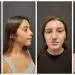 TMJ Surgery Before and After Photos