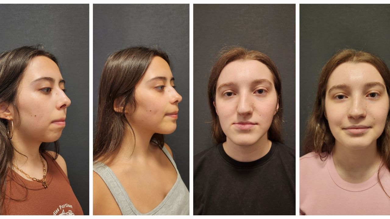 TMJ Surgery Before and After Photos