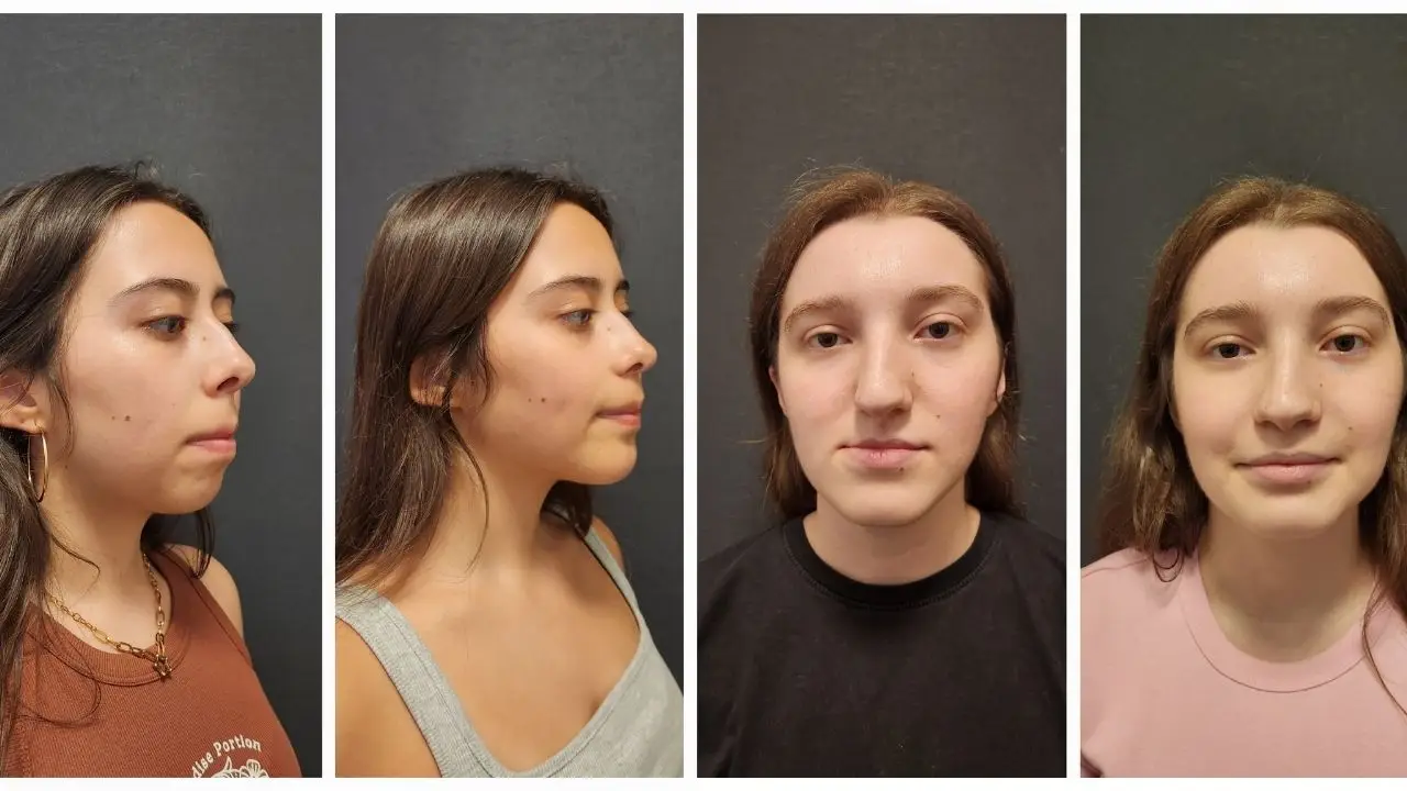 TMJ Surgery Before and After Photos