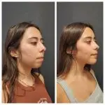 TMJ Surgery Before and After Photos