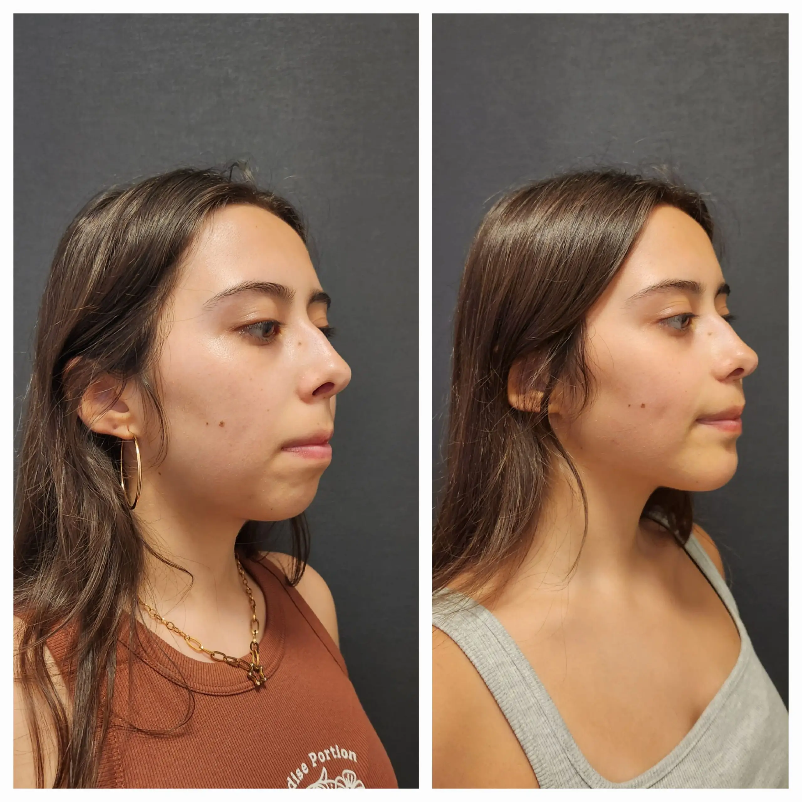 TMJ Surgery Before and After Photos