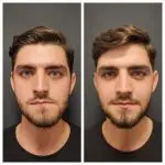 TMJ Surgery Before and After Photos