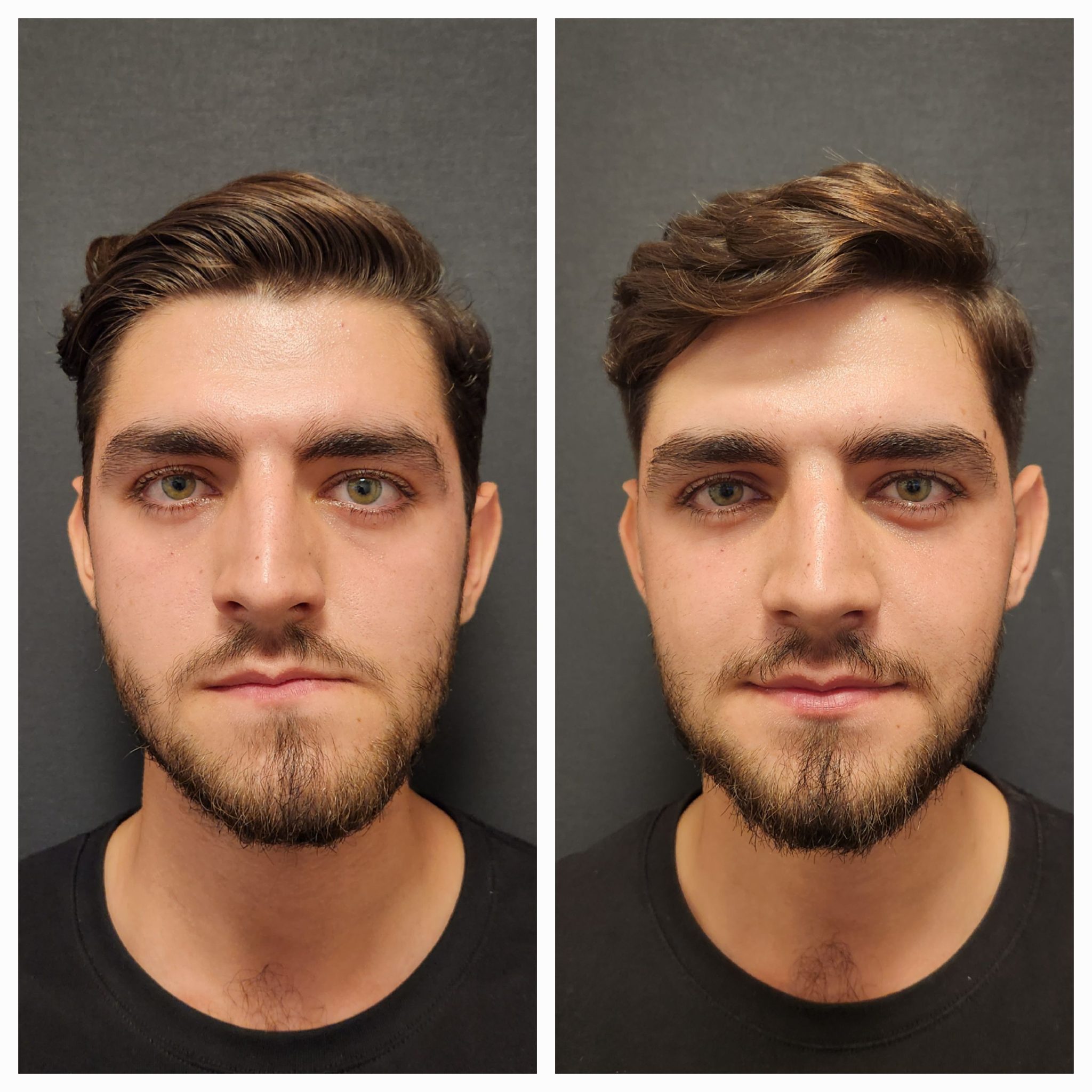 TMJ Surgery Before and After Photos