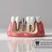 Restoring Your Smiles Against the Odds with Advanced Dental Implants for Atrophic Jaw