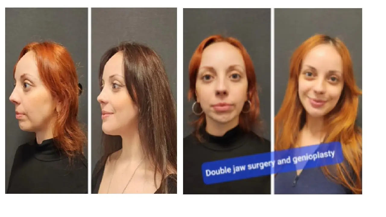 Key Differences: Orthognathic vs. Cosmetic Jaw Surgery