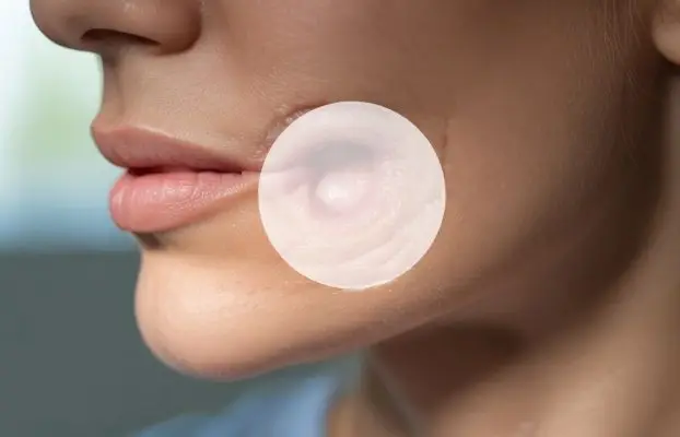 Jaw Cyst Removal in Istanbul by Prof. Dr. Celal Çandırlı