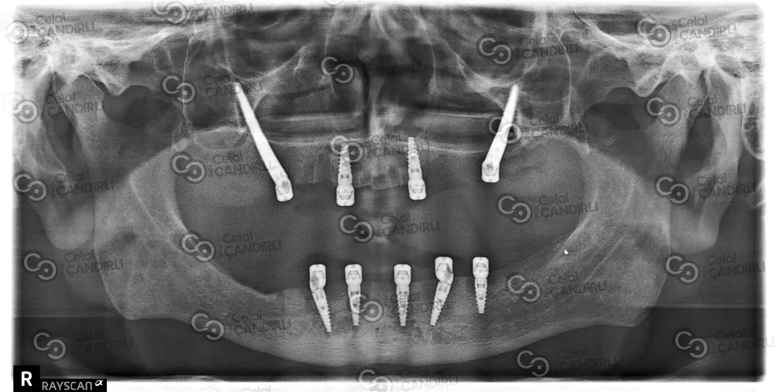 Zigoma İmplantı ile Zigoma Estetiği Aynı Şey midir