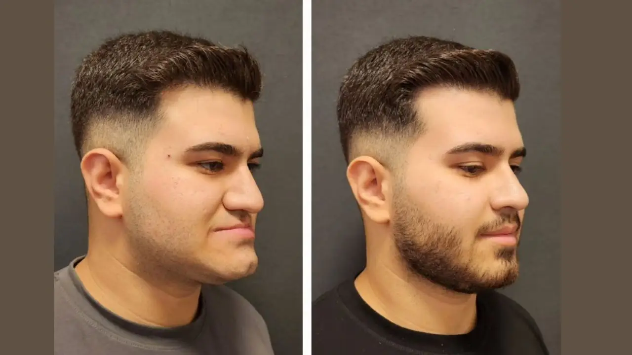 Chin Implant Before After Procedure