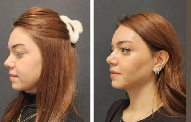 Silicone Chin Implant Procedure and Patient Experiences