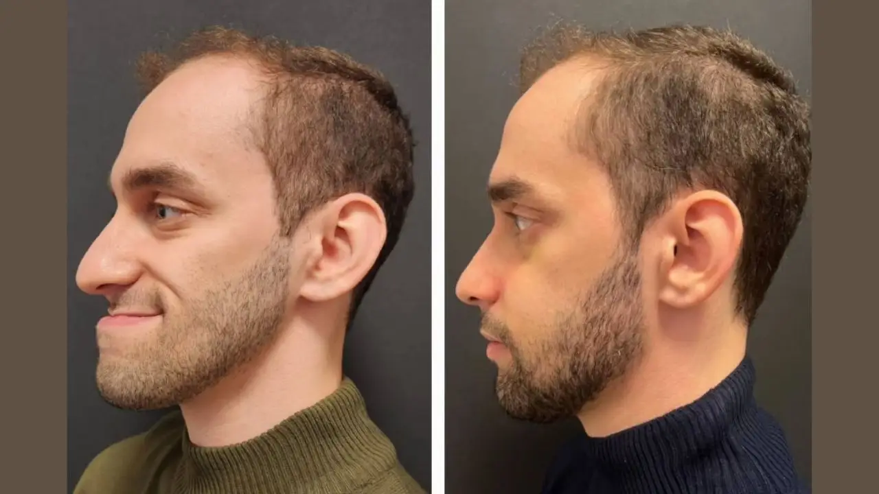 Pre-Operative Considerations of Chin Implant Before After