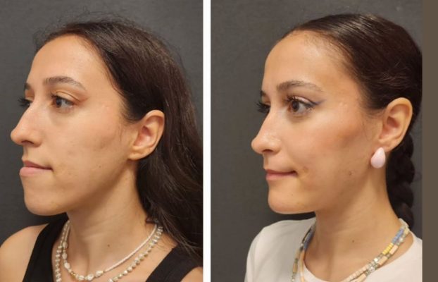 Chin Implant Before After Procedure