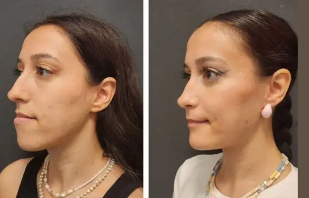 Chin Implant Before After Procedure