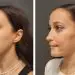 Chin Implant Before After Procedure