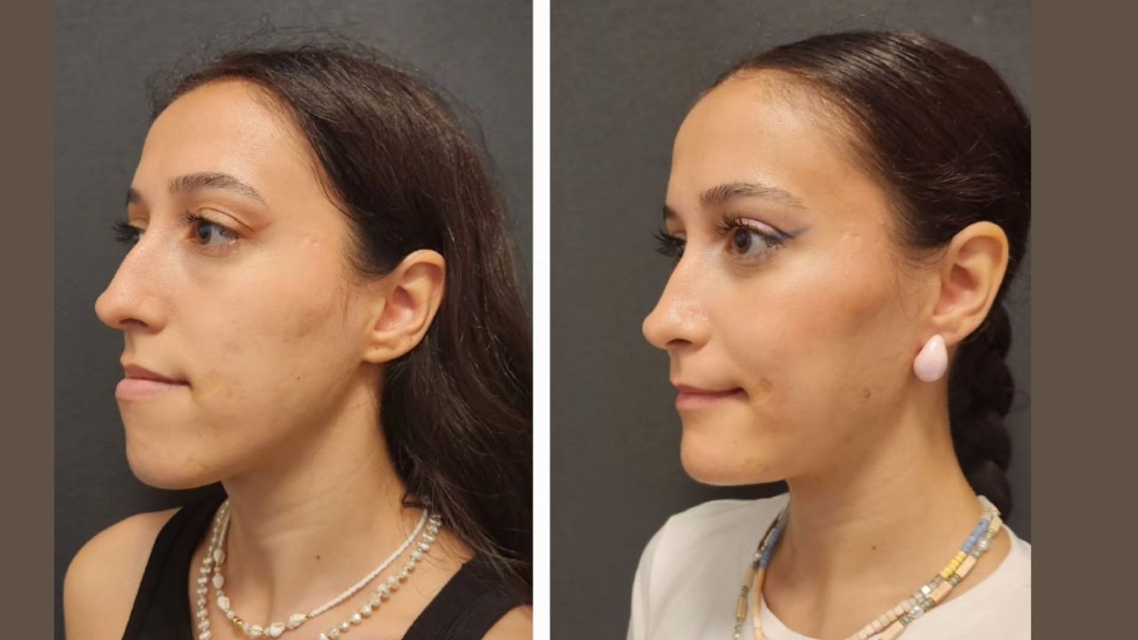 Chin Implant Before After Procedure