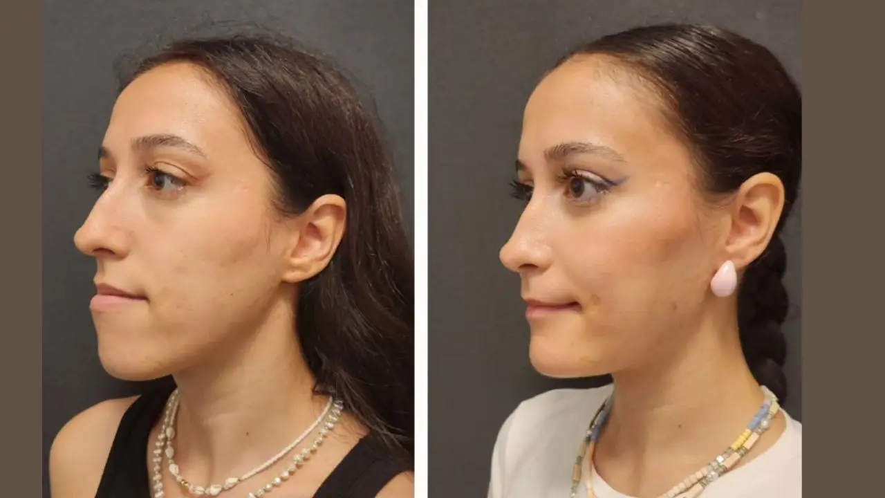Chin Implant Before After Procedure