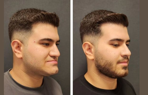 How Is a Chin Implant Procedure Performed?