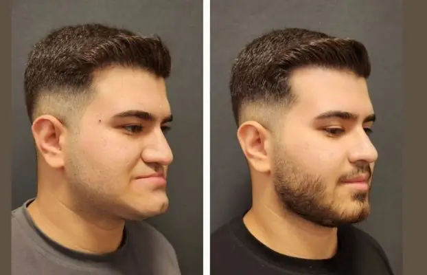How Is a Chin Implant Procedure Performed?