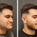 What Is a Chin Implant Procedure?