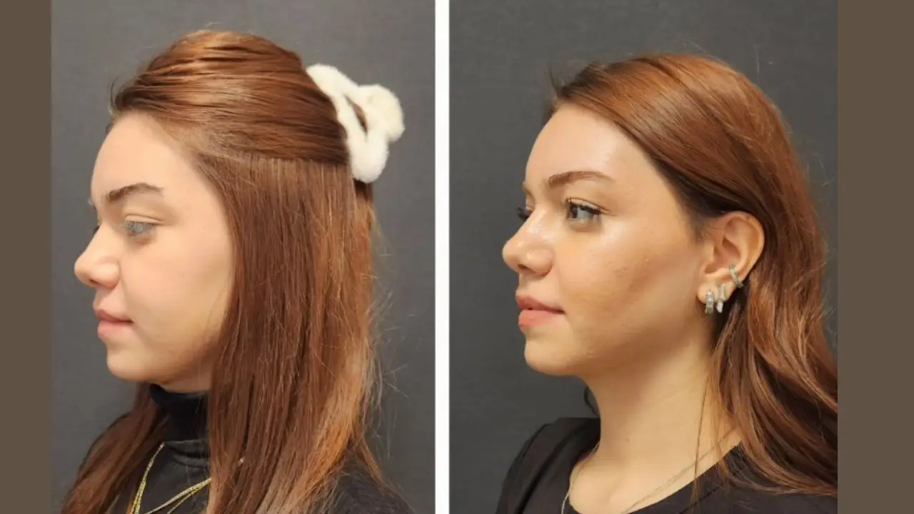 How Is Chin Implant Surgery Performed?