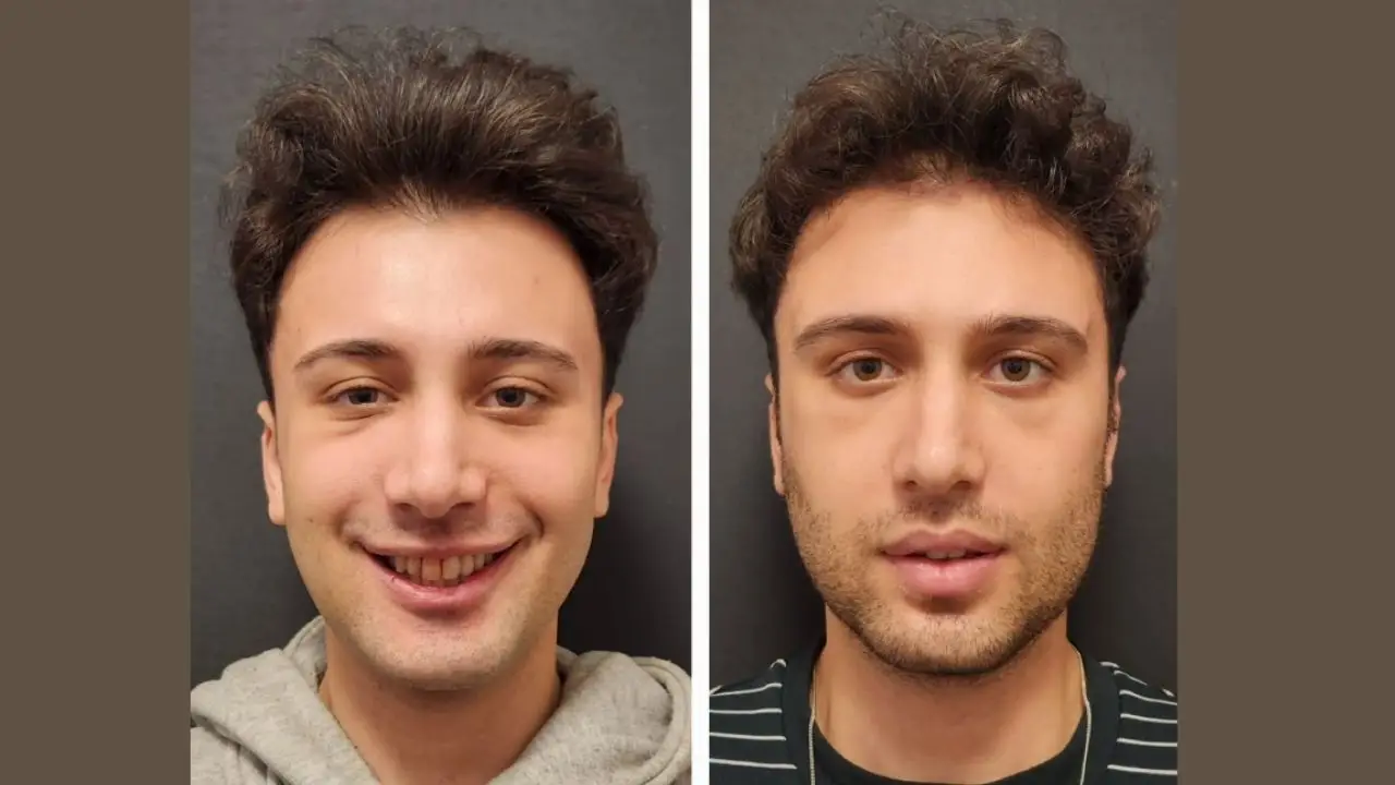 Post-Operative Care After Chin Implant Surgery