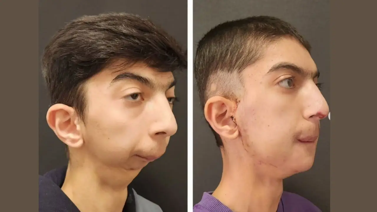 How Is a Chin Implant Procedure Performed?