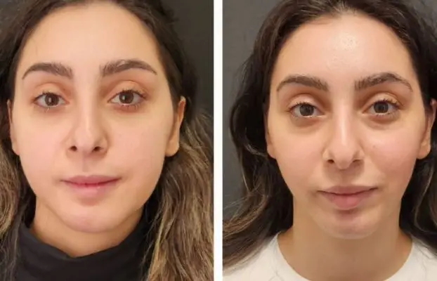 Jawline Contouring in Turkey 2026 (Cost, Techniques, and Results)