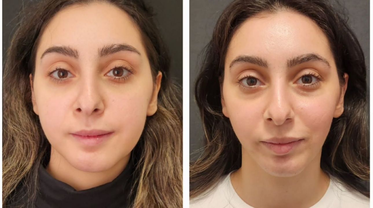 Jawline Contouring in Turkey 2026 (Cost, Techniques, and Results)
