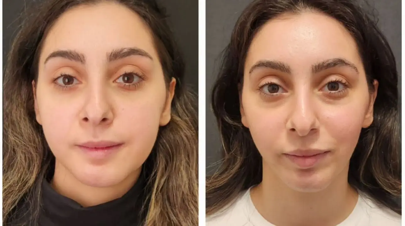 Jawline Contouring in Turkey 2026 (Cost, Techniques, and Results)
